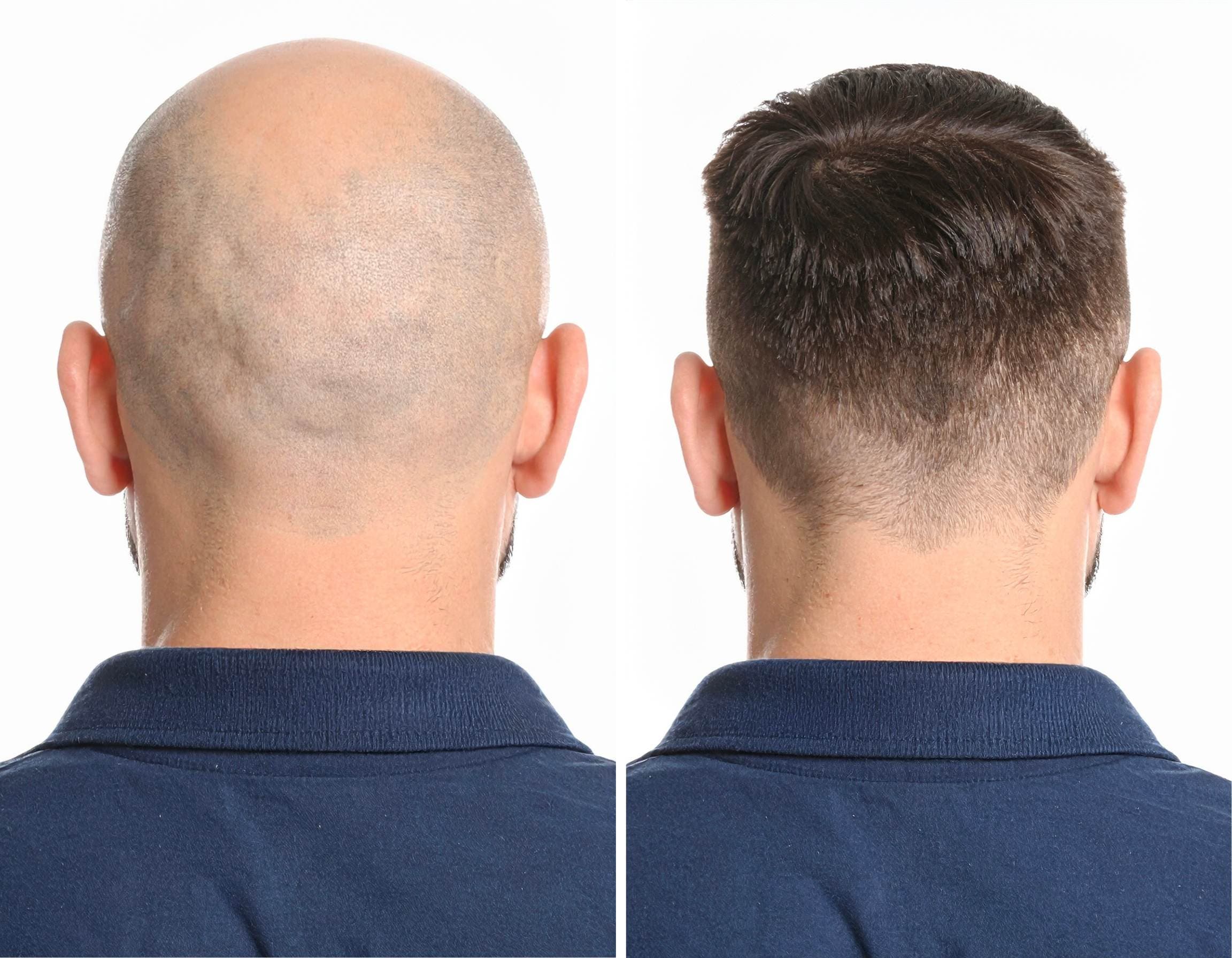 Haartransplantation Vorher Nachher – Hinteransicht